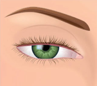 What does Ptosis look like
