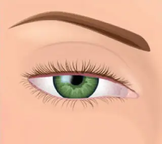 Ptosis Treatment: Elevating Your Eyes and Confidence 2 What does Ptosis look like