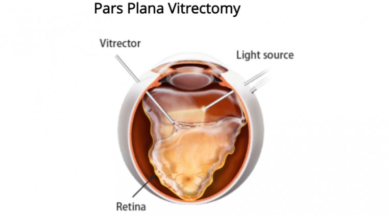 What is Pars Plana Vitrectomy