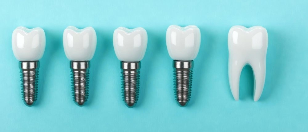 All on 4 Dental Implants