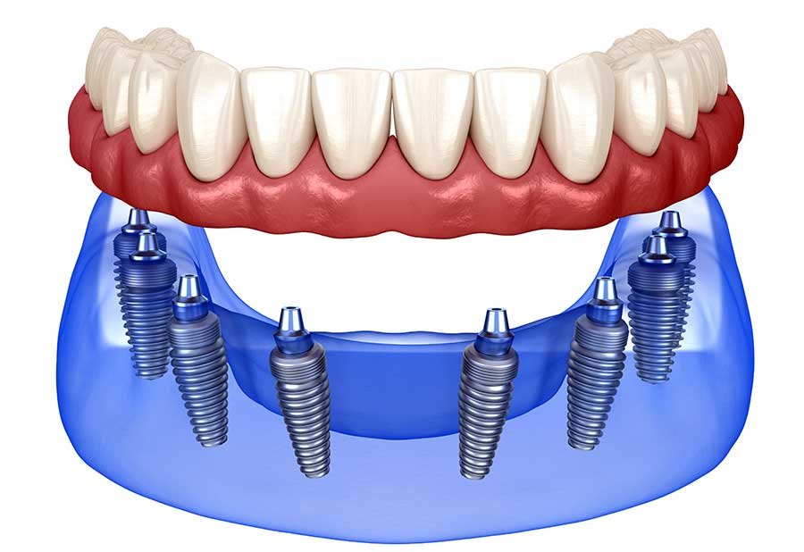 All-on-six dental implants