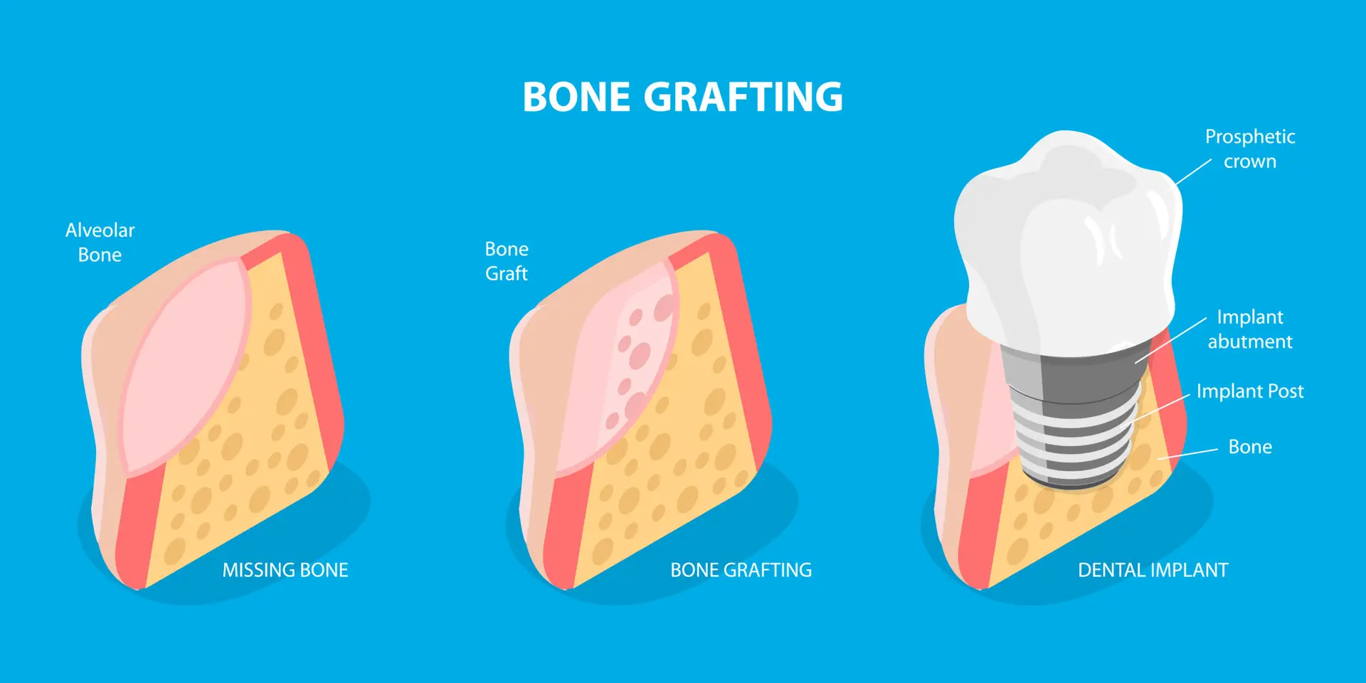 Best Dental Clinic in Turkey, Affordable Prices, Natural Results, Lifelong Guarantee 21 Dental Bone Grafting
