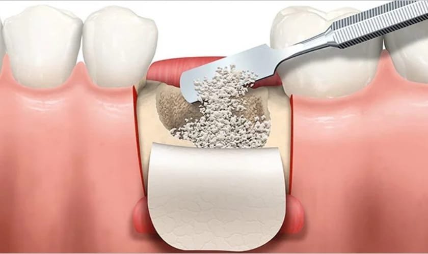 Bone grafting for dental implants photo