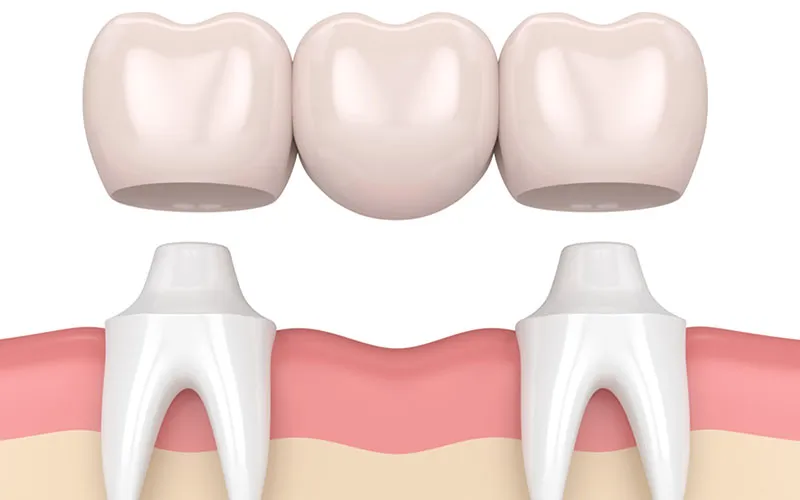 Dental Bridges