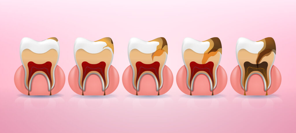 Dental Fillings