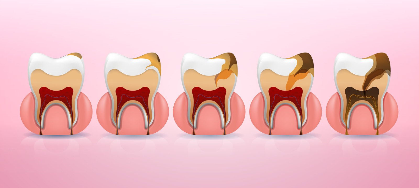 Dental Fillings