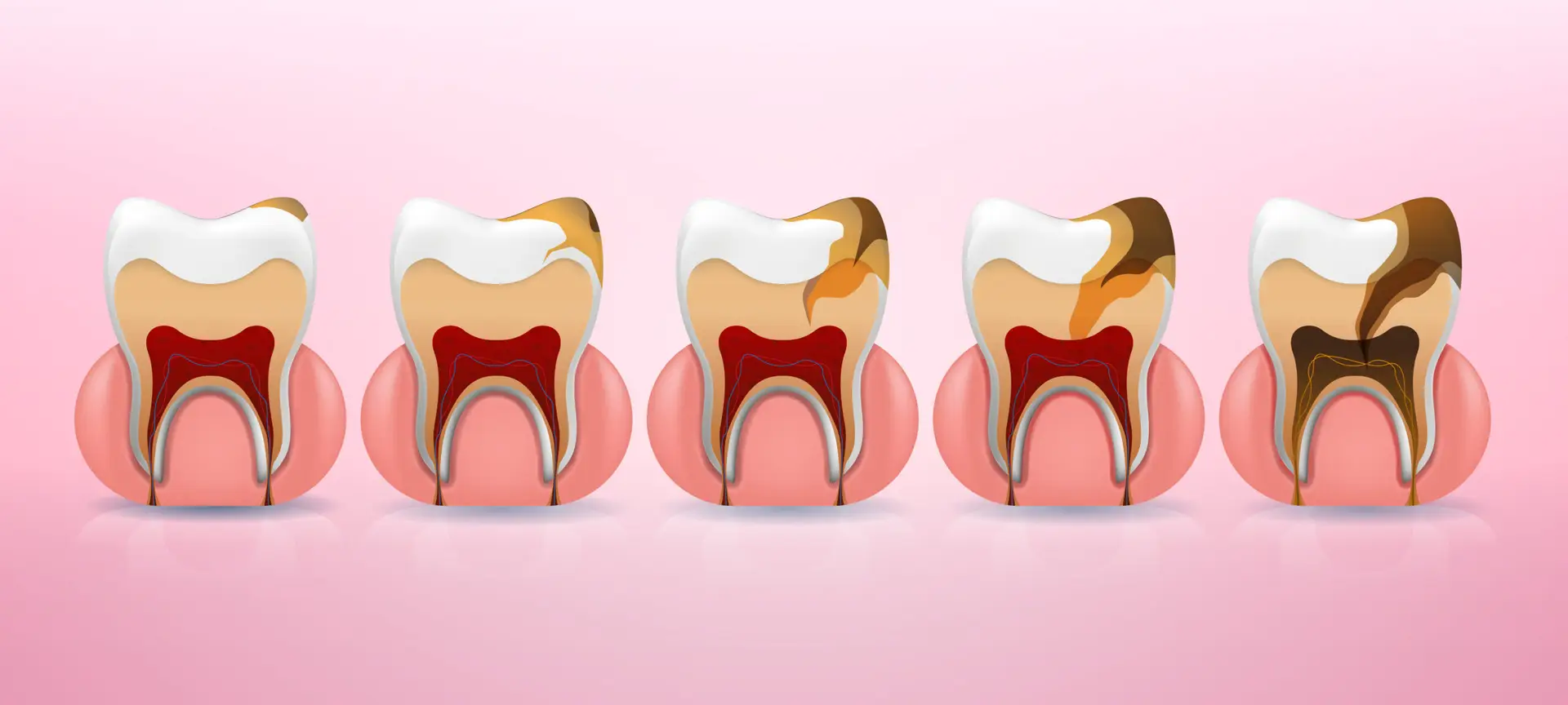 Best Dental Clinic in Turkey, Affordable Prices, Natural Results, Lifelong Guarantee 13 Dental Fillings