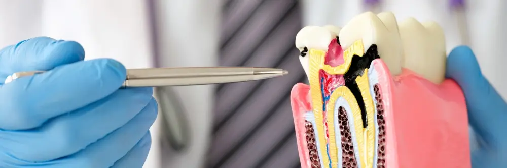 Best Dental Clinic in Turkey, Affordable Prices, Natural Results, Lifelong Guarantee 11 Root Canal Treatment