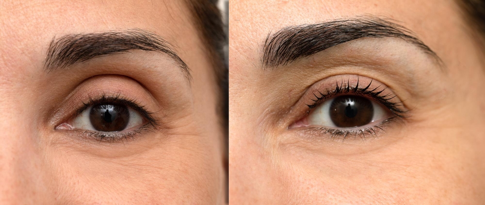 Upper Eyelid Surgery