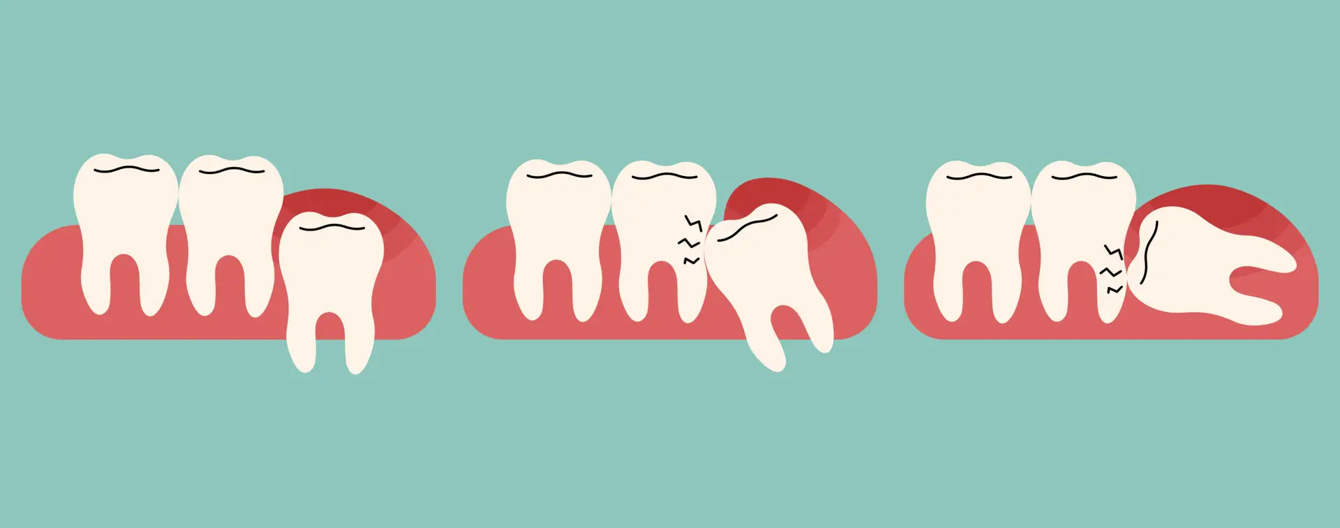 Best Dental Clinic in Turkey, Affordable Prices, Natural Results, Lifelong Guarantee 20 Wisdom Teeth Extraction