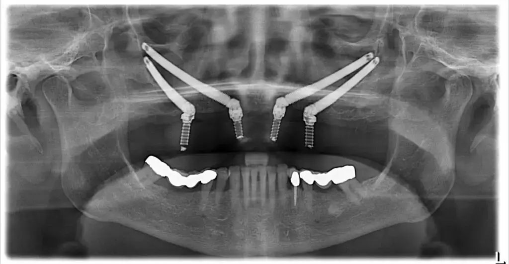 Best Dental Clinic in Turkey, Affordable Prices, Natural Results, Lifelong Guarantee 18 Zygomatic Dental Implants