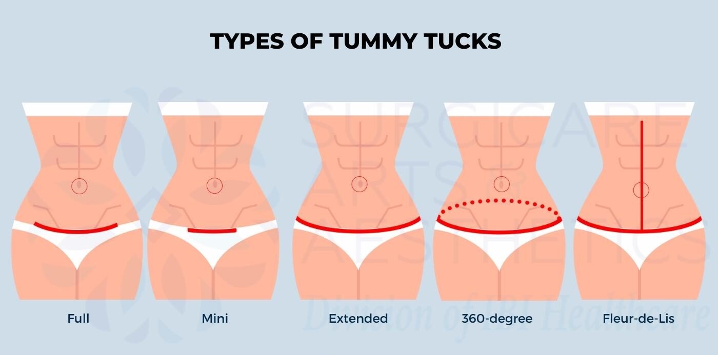 360 tummy tuck photo