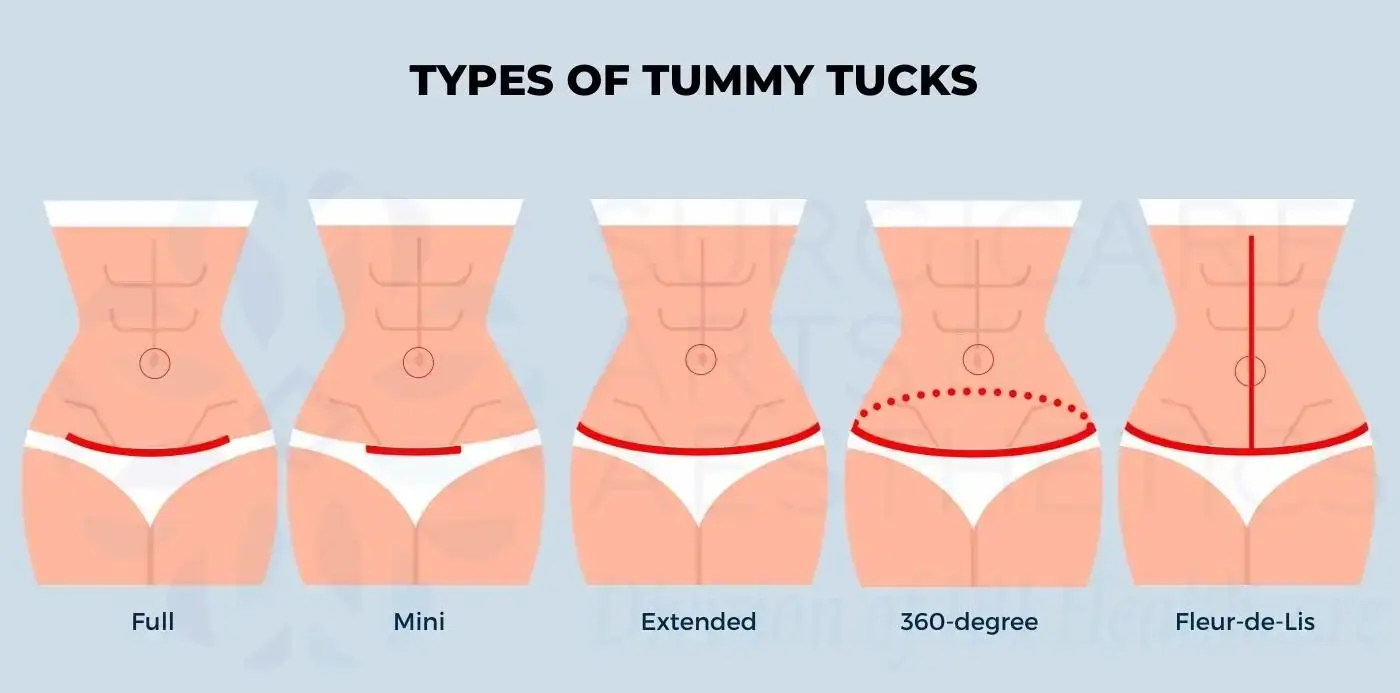 Body Lifting 4 360 tummy tuck photo
