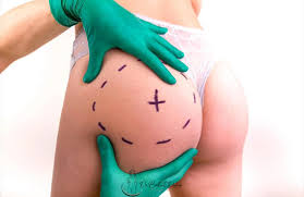 Butt & Hip Fillers in Turkey