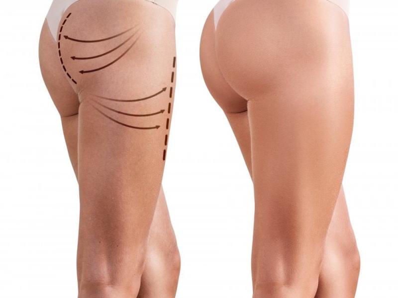 Butt & Hip Fillers