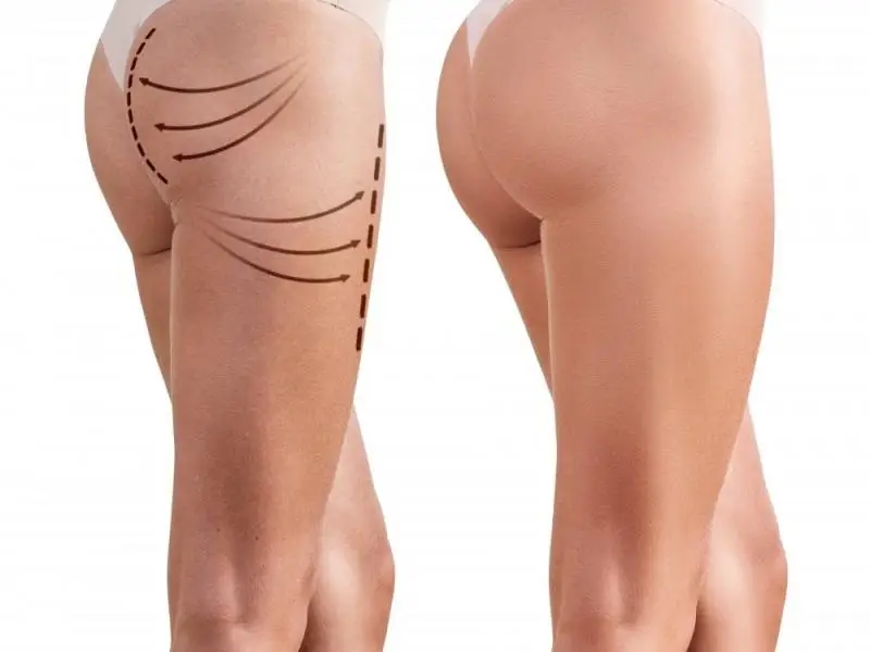 Butt & Hip Fillers in Turkey | Non-Surgical Enhancement 2 Butt & Hip Fillers