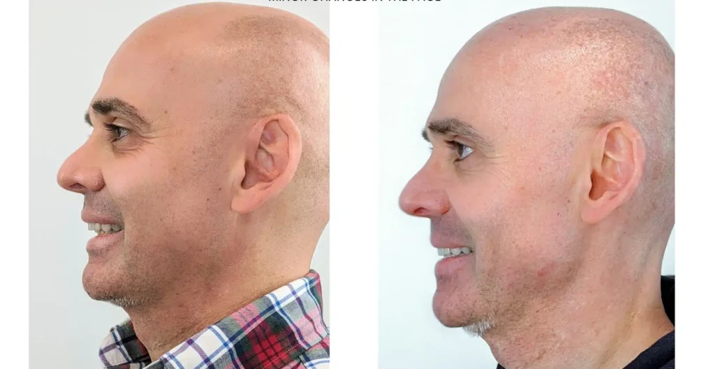 Orthognathic Surgery before & after
