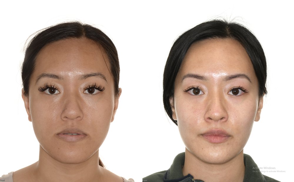 Orthognathic Surgery before and after