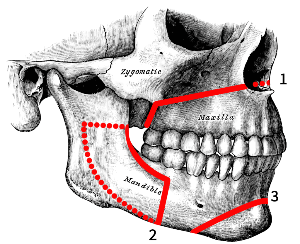 What is Orthognatic surgery