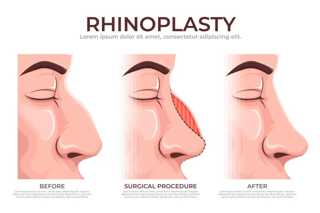 Top 7 most affordable countries for rhinoplasty nose job in the world 219 Affordable nose surgery countries photo