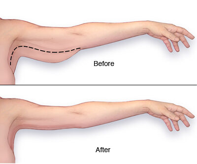 Arm Lift before after photo