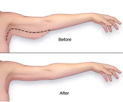 Body Lifting 7 Arm Lift before after photo