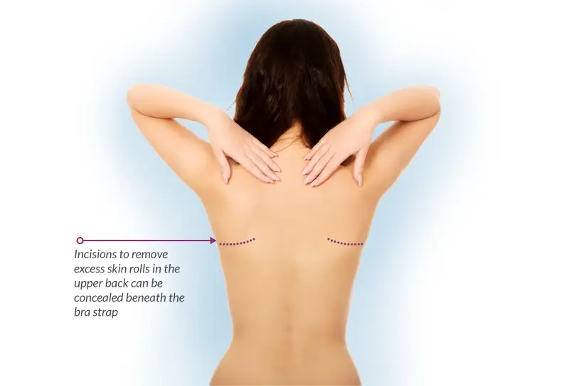 Body Lifting 8 Back Lift Photos