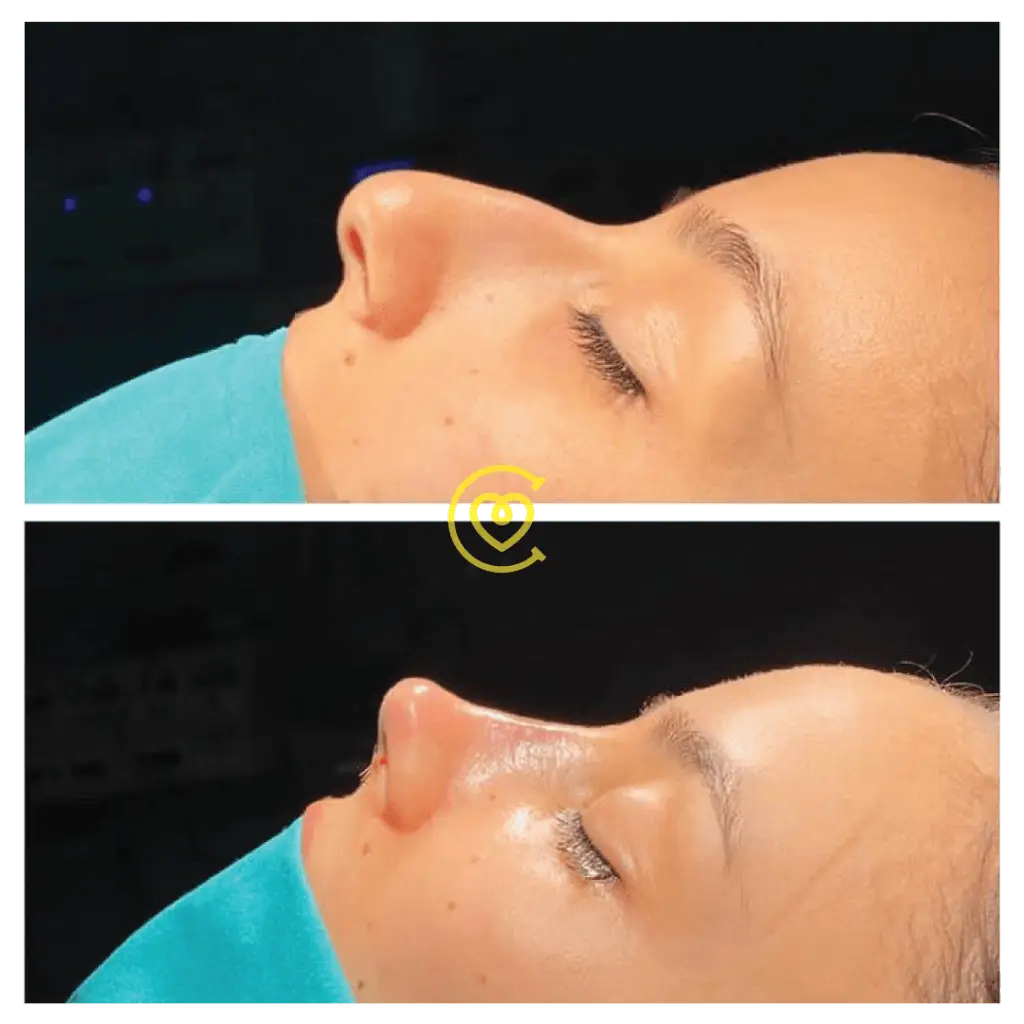 Barbie Nose Rhinoplasty: 7 Tips for Realistic Expectations 197 Barbie Doll Nose Rhinoplasty