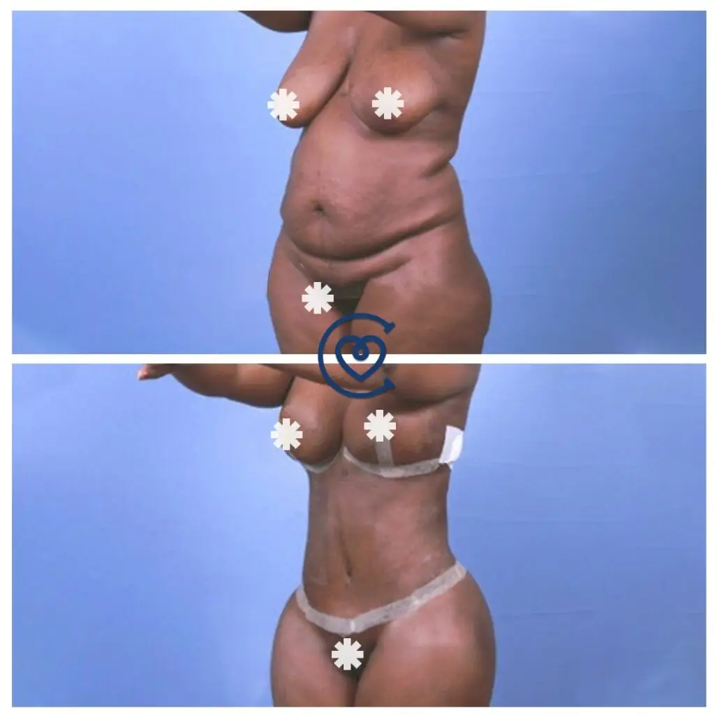 Mommy Makeover in Turkey, Packages and Costs 2025 6 Body lifting before after photo