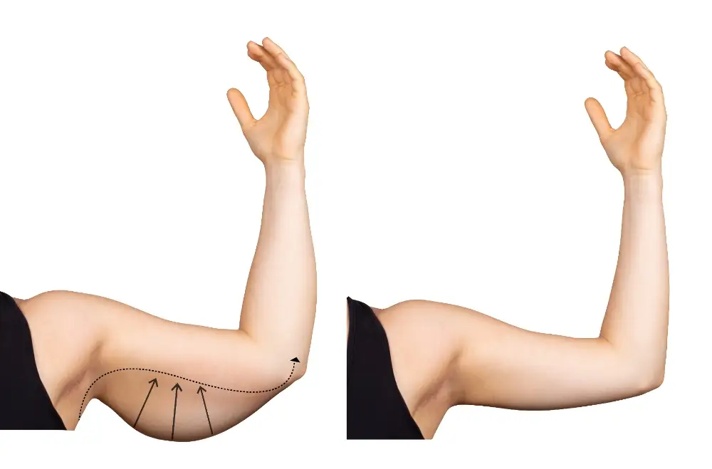 What to expect before and after liposuction 2025 4 Life after arm liposuction photo