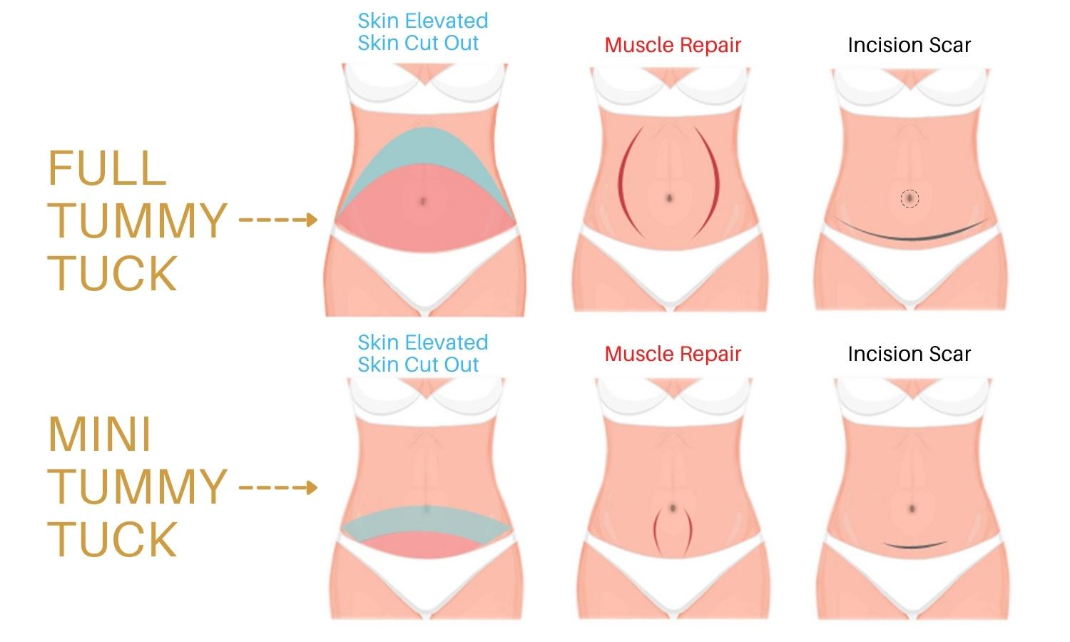 Mini Tummy Tuck Photos