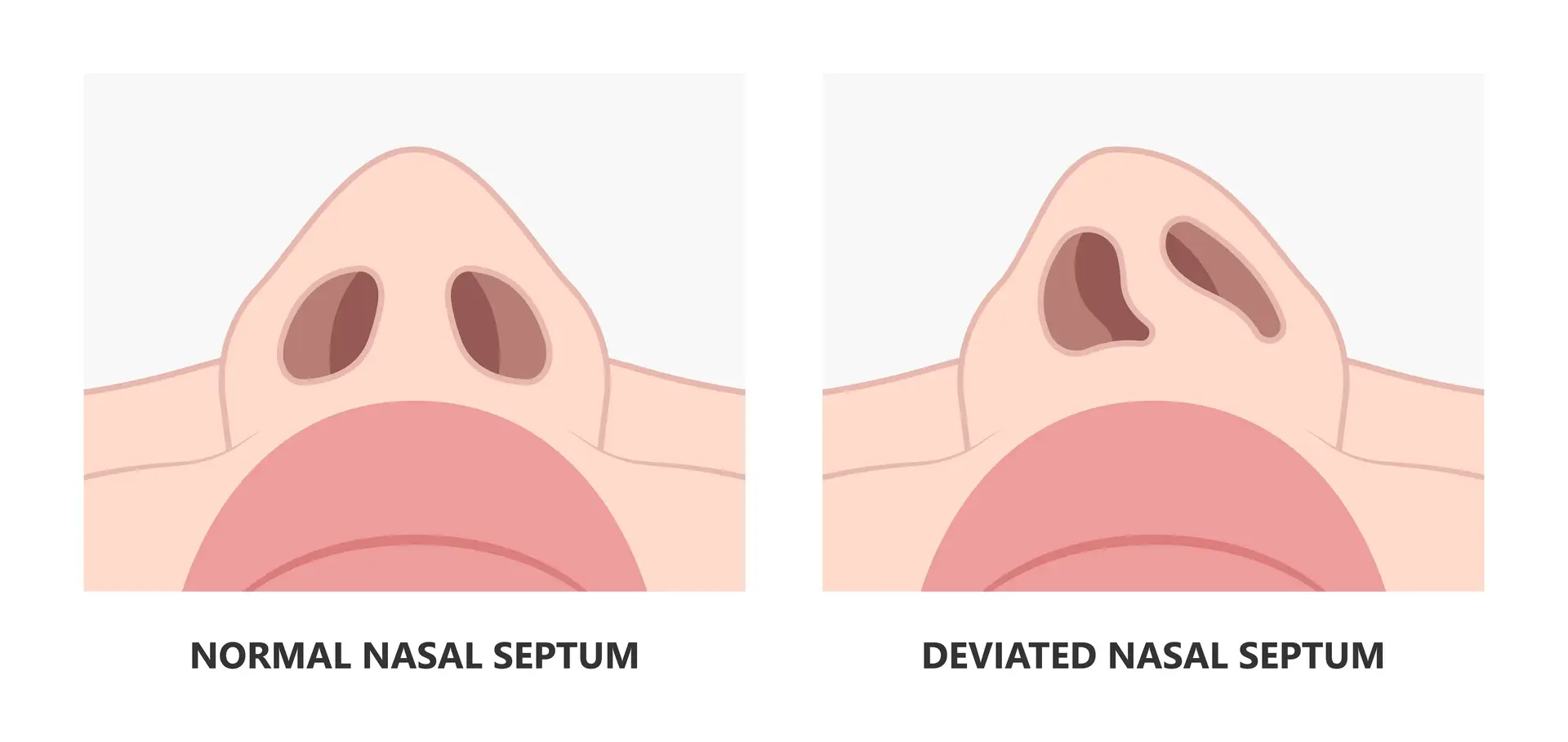 Nose Job in Turkey - Rhinoplasty Surgery 9 Nasal Septum Deviation