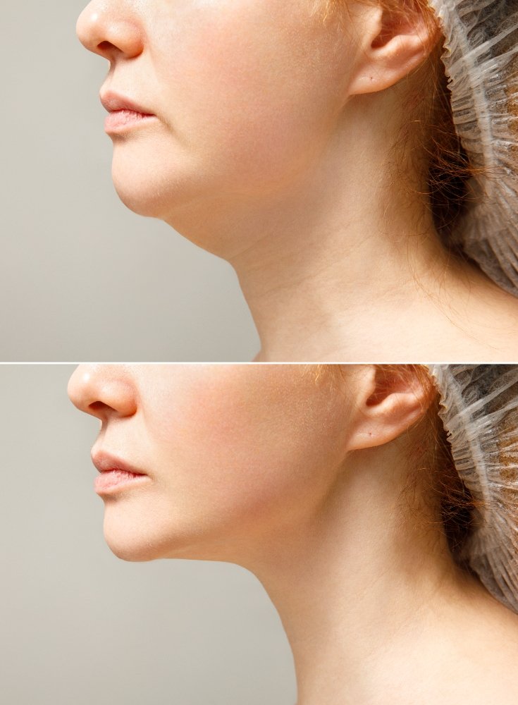 Neck liposuction before after photo