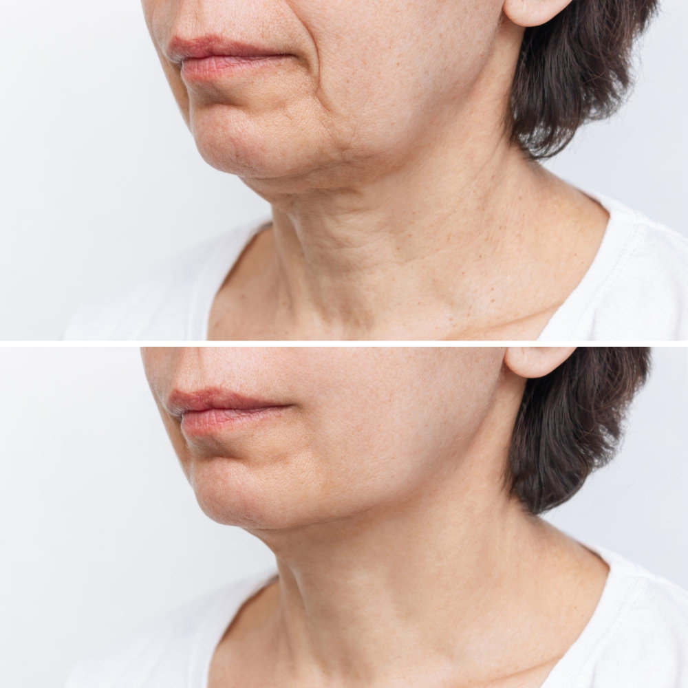 neck liposuction double chin photo