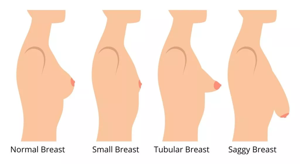 Tuberous Breast photo