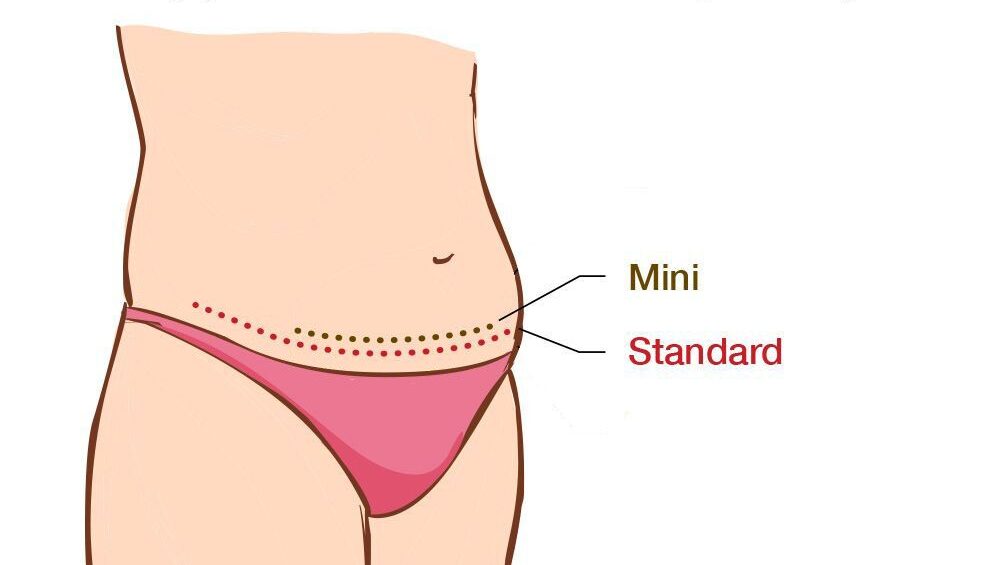 Tummy Tuck Surgery