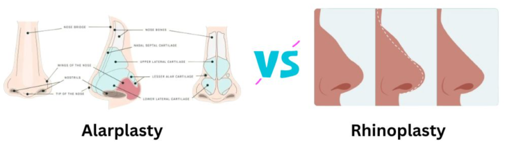 Which one is better alarplasty and rhinoplasty