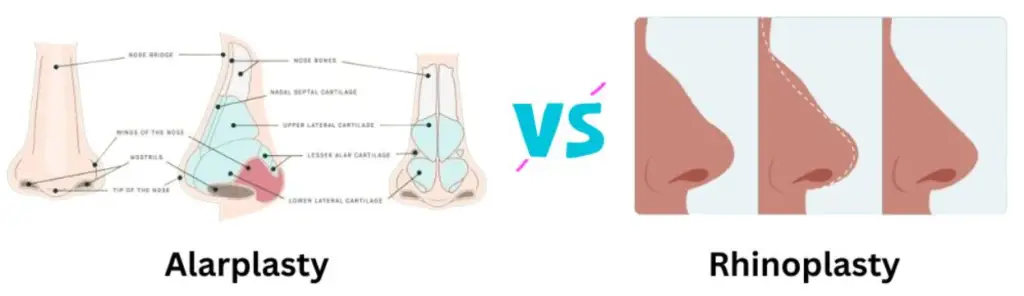 Which Is Better Alarplasty Or Rhinoplasty? 195 Which one is better alarplasty and rhinoplasty