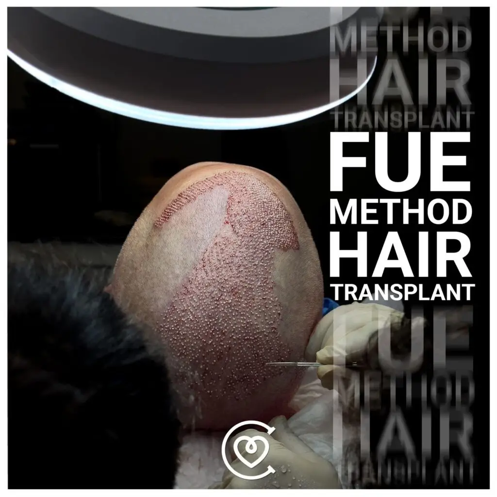 Affordable Hair Transplant for Women In Turkey 2 FUE-Hair-Transplant-Procedure