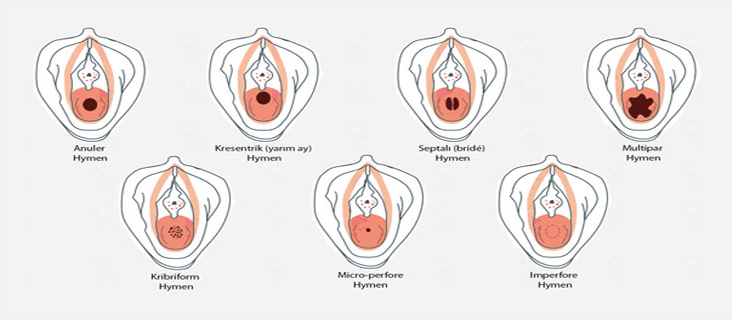 Different Hymen repair surgery photos