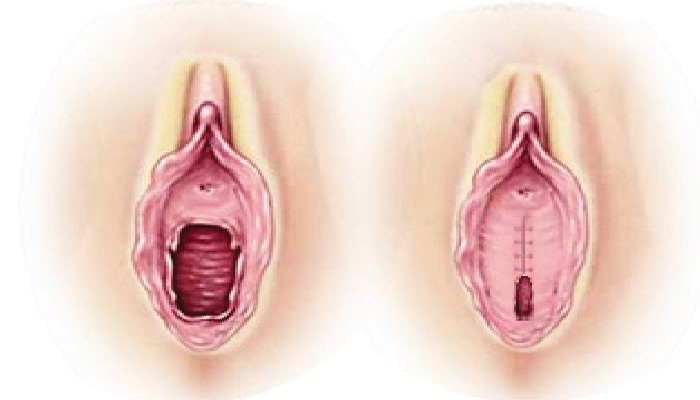 Hymen repair before after photo