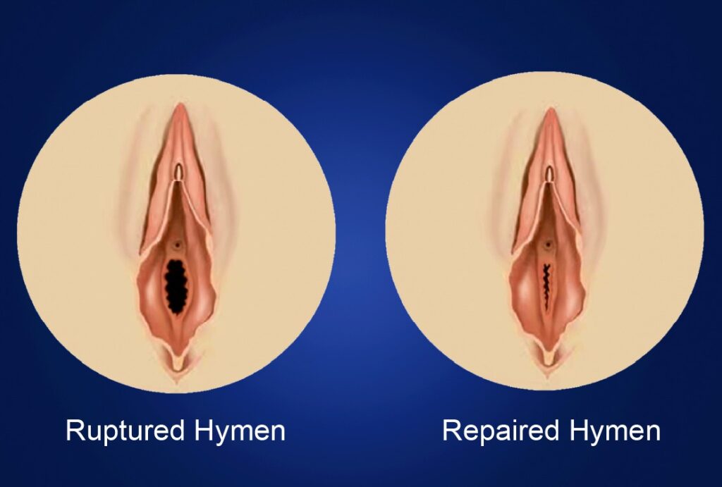 Hymenoplasty before and after photo