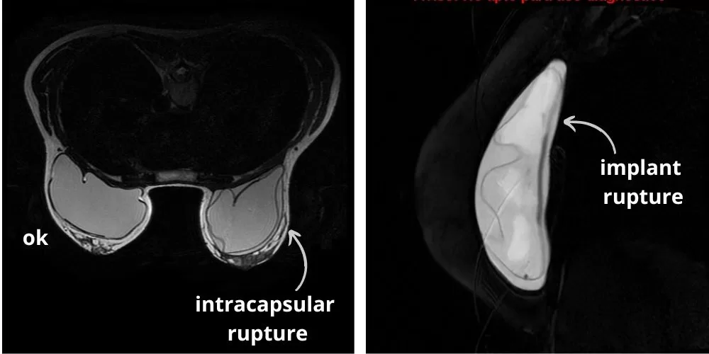 Breast Implant Rupture