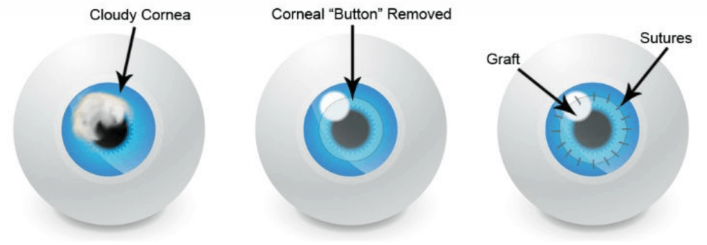 Corneal Transplant Procedure