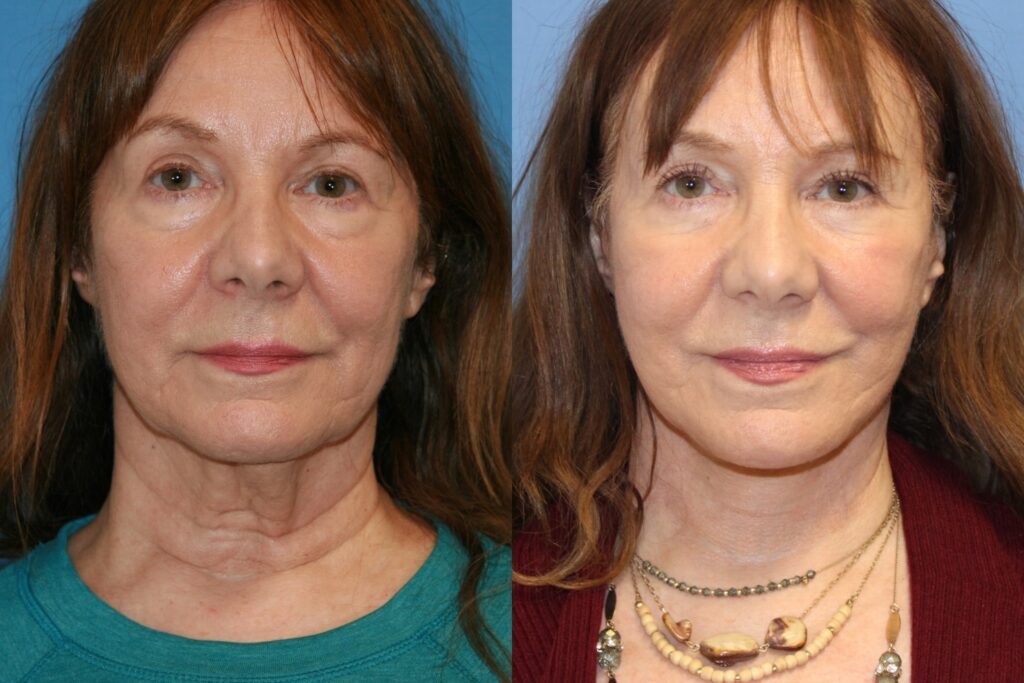 Face and Neck Lift Before and After