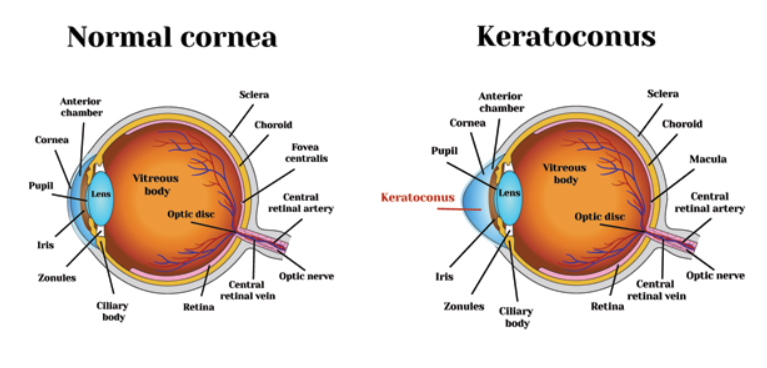 Keratoconus Photo