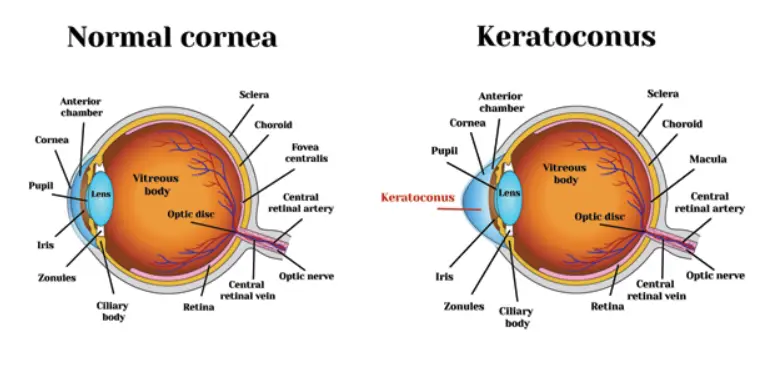 Cornea Transplant For Keratoconus