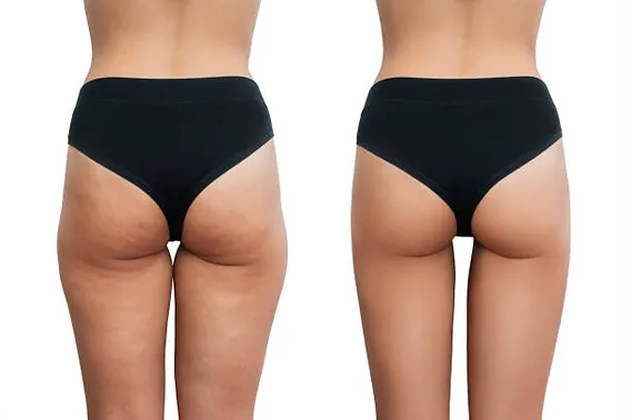 Thigh lift before and after