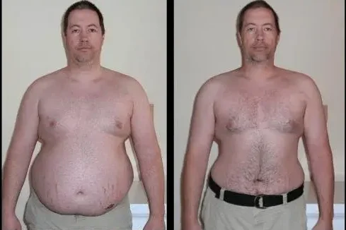 Tummy Tuck Surgery Before & After