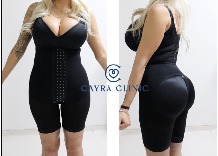 Compression garments after plastic surgery photo